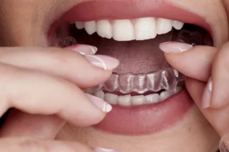 Invisalign, Skydents Dental, Dr. Lakshman Rao Kondapalli