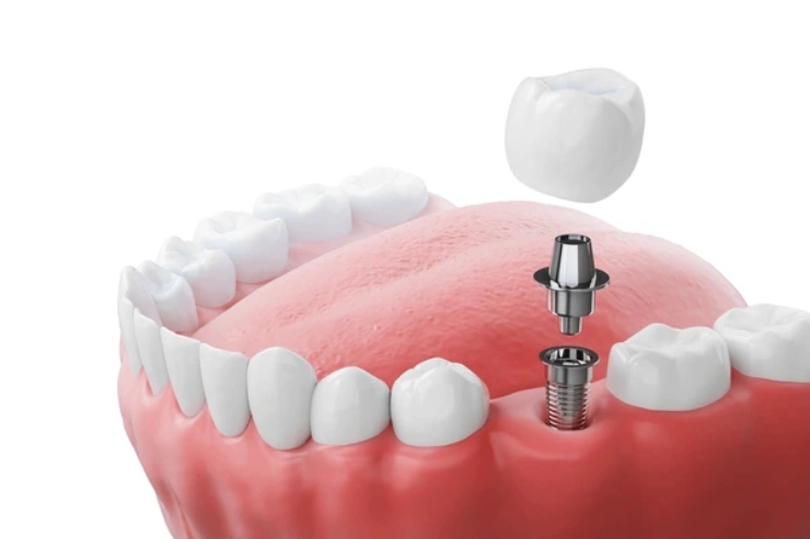 Dental Implants, Skydents Dental, Dr. Lakshman Rao Kondapalli